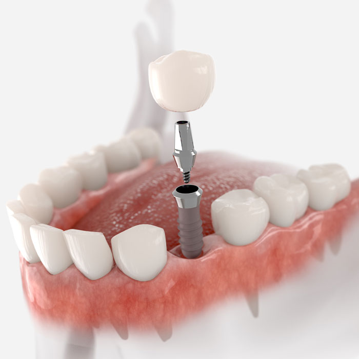 single dental implant model